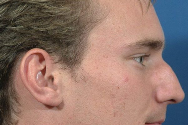 rhinoplasty-9