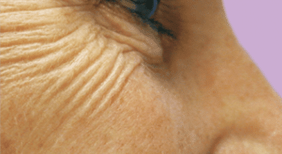 eye wrinkles