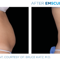 Emsculpt female abdomen profile