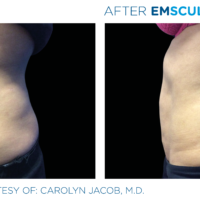 Emsculpt male abdomen