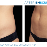 Emsculpt_PIC_Ba-card-female-abdomen-011_ENUS100