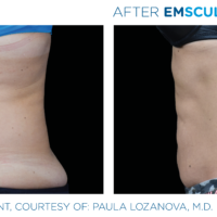 Emsculpt_PIC_Ba-card-female-abdomen-022_ENUS100