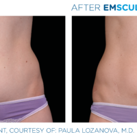 Emsculpt_PIC_Ba-card-female-abdomen-026_ENUS100