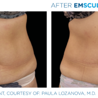 Emsculpt_PIC_Ba-card-female-abdomen-027_ENUS100