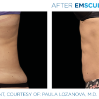 Emsculpt_PIC_Ba-card-female-abdomen-029_ENUS100