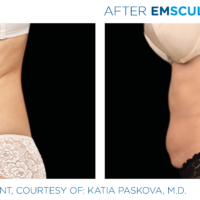 Female torso Emsculpt before and after