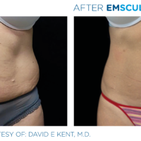 Tummy before and after Emsculpt