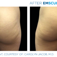 Emsculpt_PIC_Ba-card-female-buttock-005_ENUS100