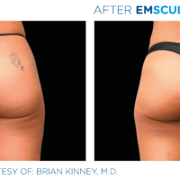 Emsculpt female buttock