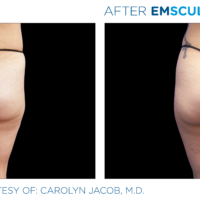 Emsculpt_PIC_Ba-card-female-buttock-018_ENUS100