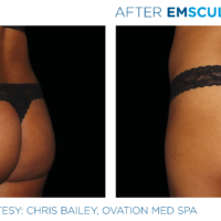 Emsculpt_PIC_Ba-card-female-buttock-036_ENUS100