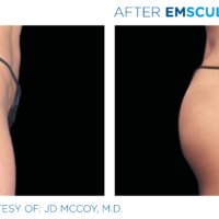 Female buttock before and after Emsculpt