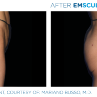 Buttock before and after Emsculpt