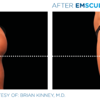 Emsculpt_PIC_Ba-card-female-buttock-042_ENUS100