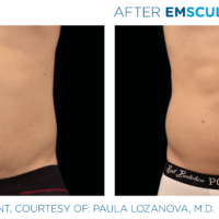 Emsculpt of male abdomen after