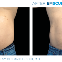 After Emsculpt male stomach