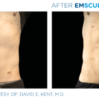 After Emsculpt male abs