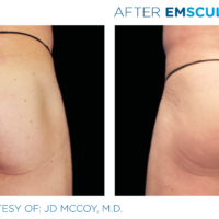 Male buttock after Emsculpt