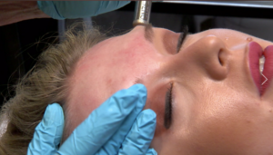 microdermabrasion demonstration procedure