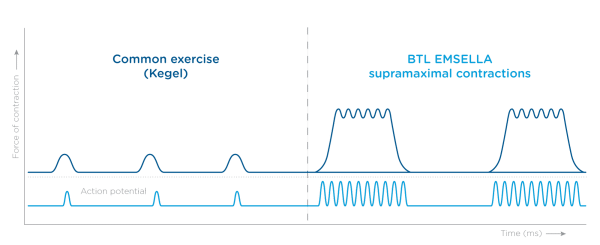 BTL Emsella myogram cincinnati