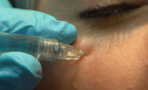 Vollure filler under eyelids tear trough filler