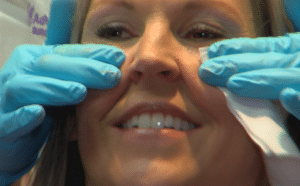 Vollure filler under eyelids tear trough filler