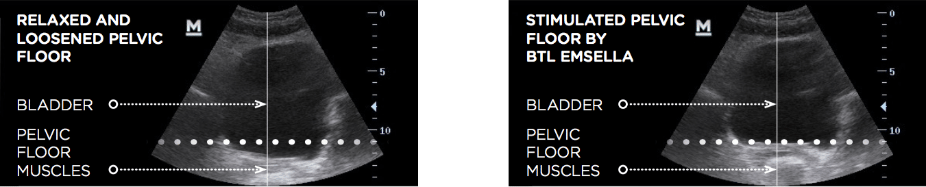 emsella-pelvic-floor-xrays