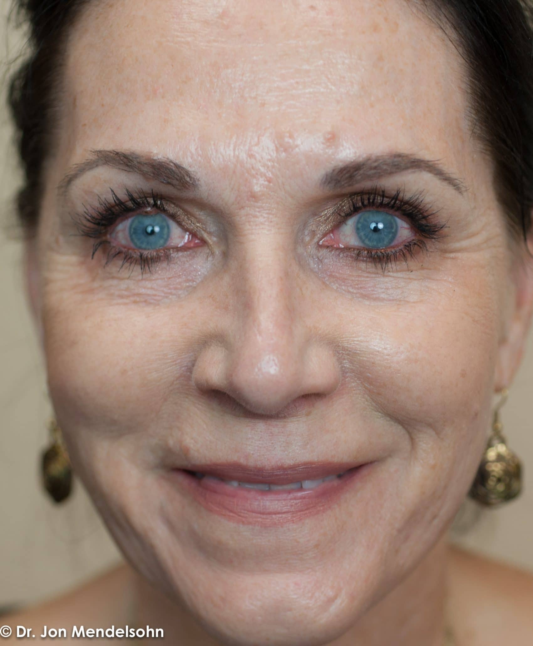 Upper-blepharoplasty-eyelid-surgery-cincinnati-dr-jon-mendelsohn-best-eyelid-surgery-plastic-surgery-realself-truseselfies-frontal-after-Drake-Robin-7474-2