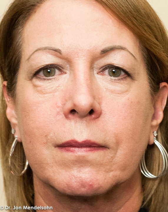 Upper-blepharoplasty-eyelid-surgery-cincinnati-dr-jon-mendelsohn-best-eyelid-surgery-plastic-surgery-realself-truseselfies-frontal-before-20160923-McDaniel_Jane-34779-2