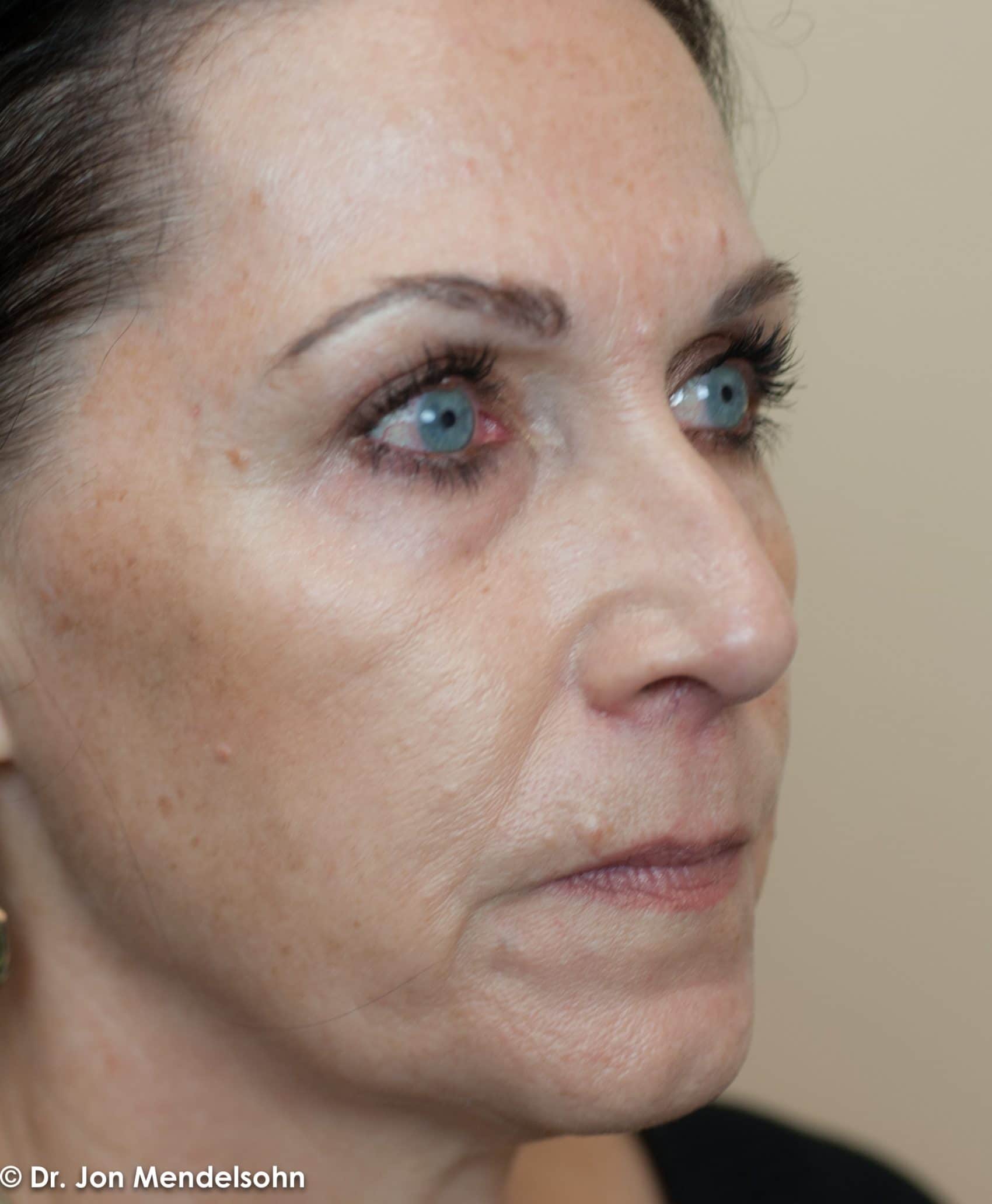 Upper-blepharoplasty-eyelid-surgery-cincinnati-dr-jon-mendelsohn-best-eyelid-surgery-plastic-surgery-realself-truseselfies-three-quarter-right-after-Drake-Robin-7477-2