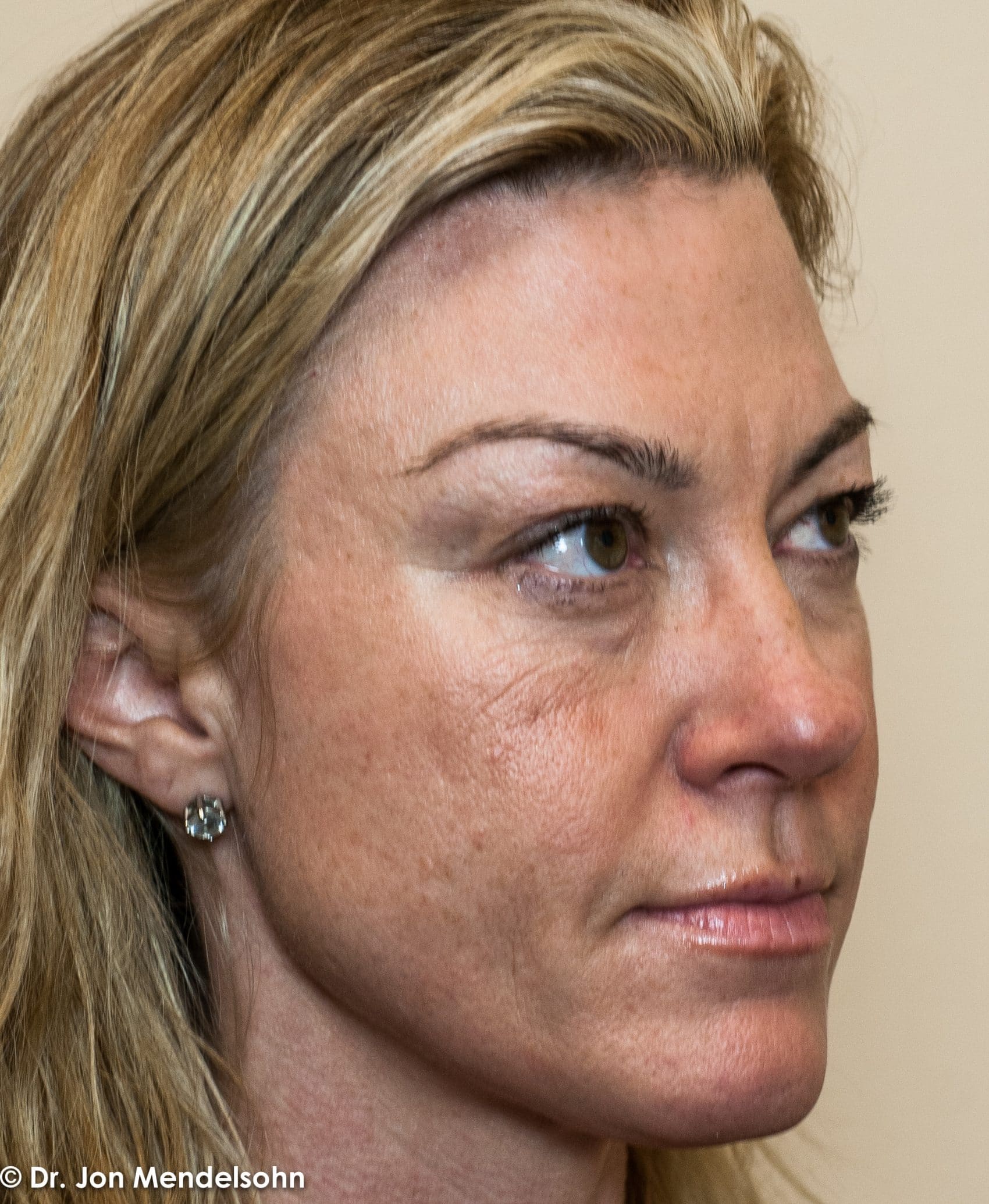 Upper-blepharoplasty-eyelid-surgery-cincinnati-dr-jon-mendelsohn-best-eyelid-surgery-plastic-surgery-realself-truseselfies-three-quarter-right-before-Krishock_Laurissa-5 2-2