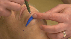 marking surgery for chin implant