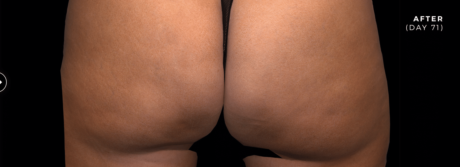 after qwo cellulite results
