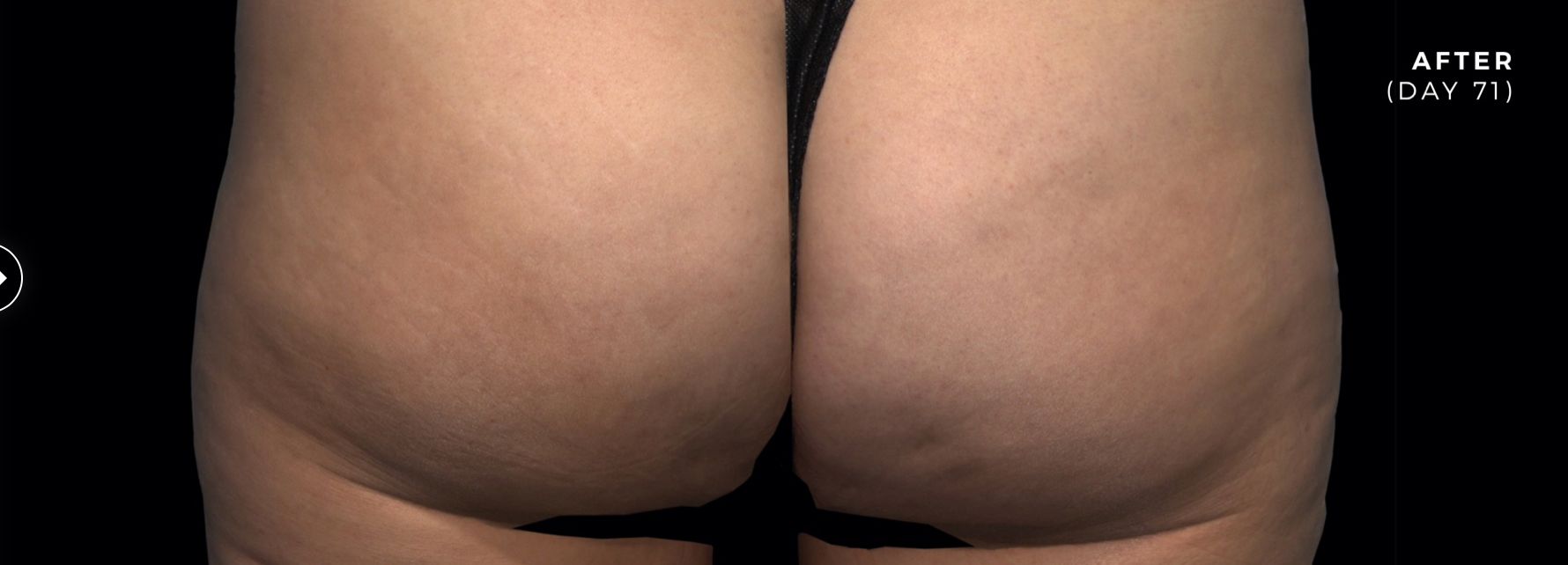 after photo of qwo cellulite