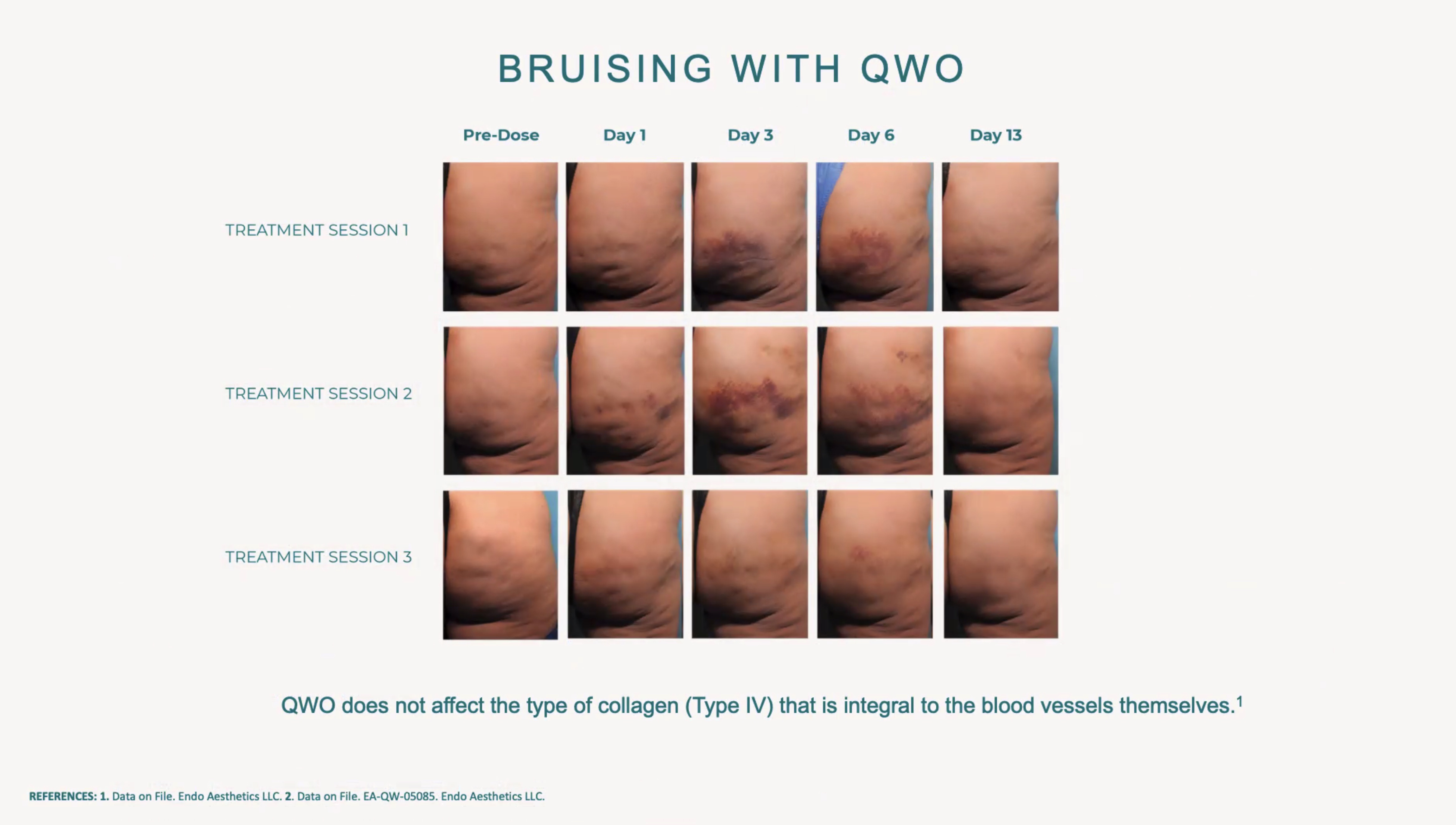 bruising with qwo treatment sessions