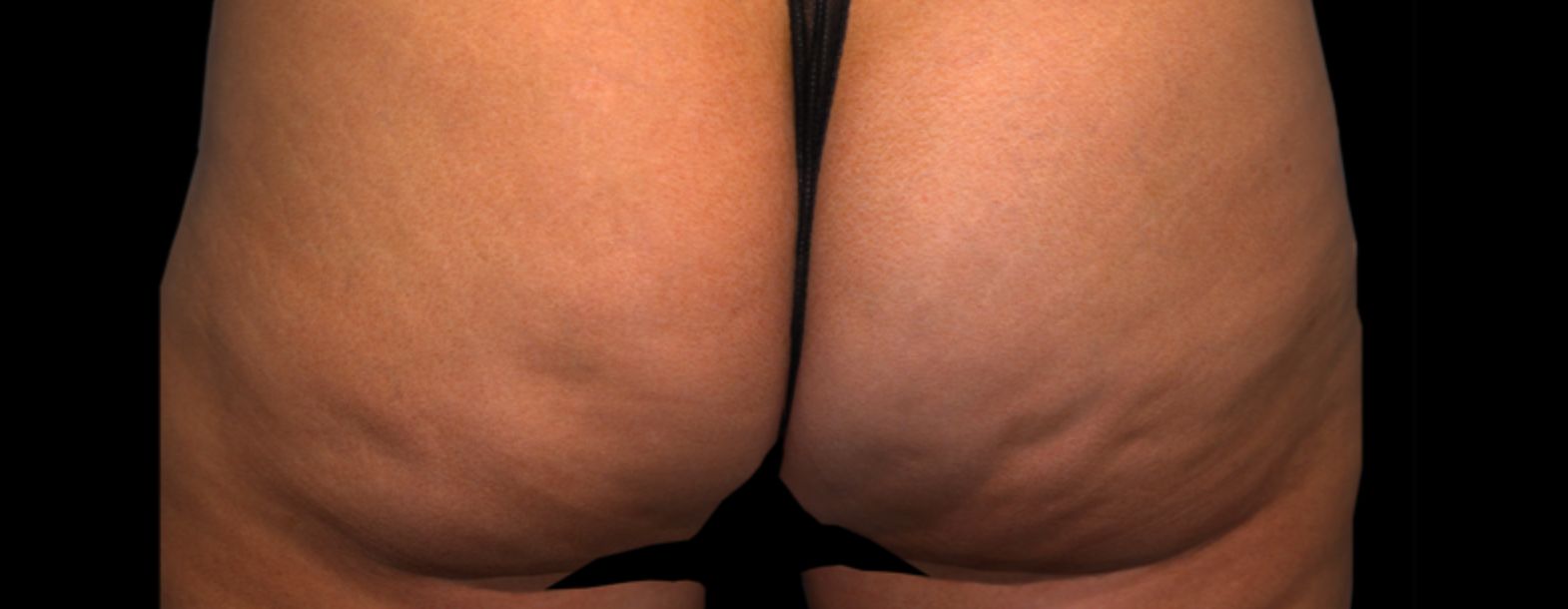 before qwo cellulite results