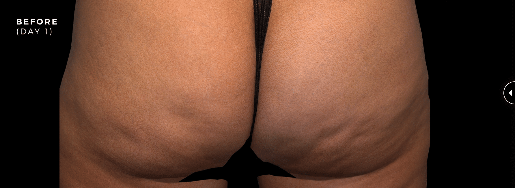 before qwo cellulite image