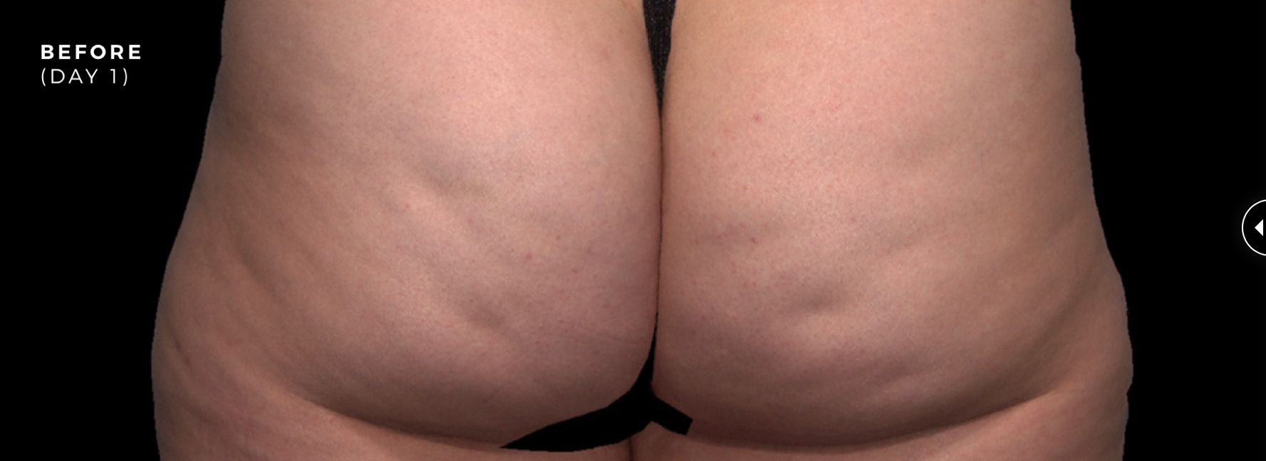 qwo cellulite before image