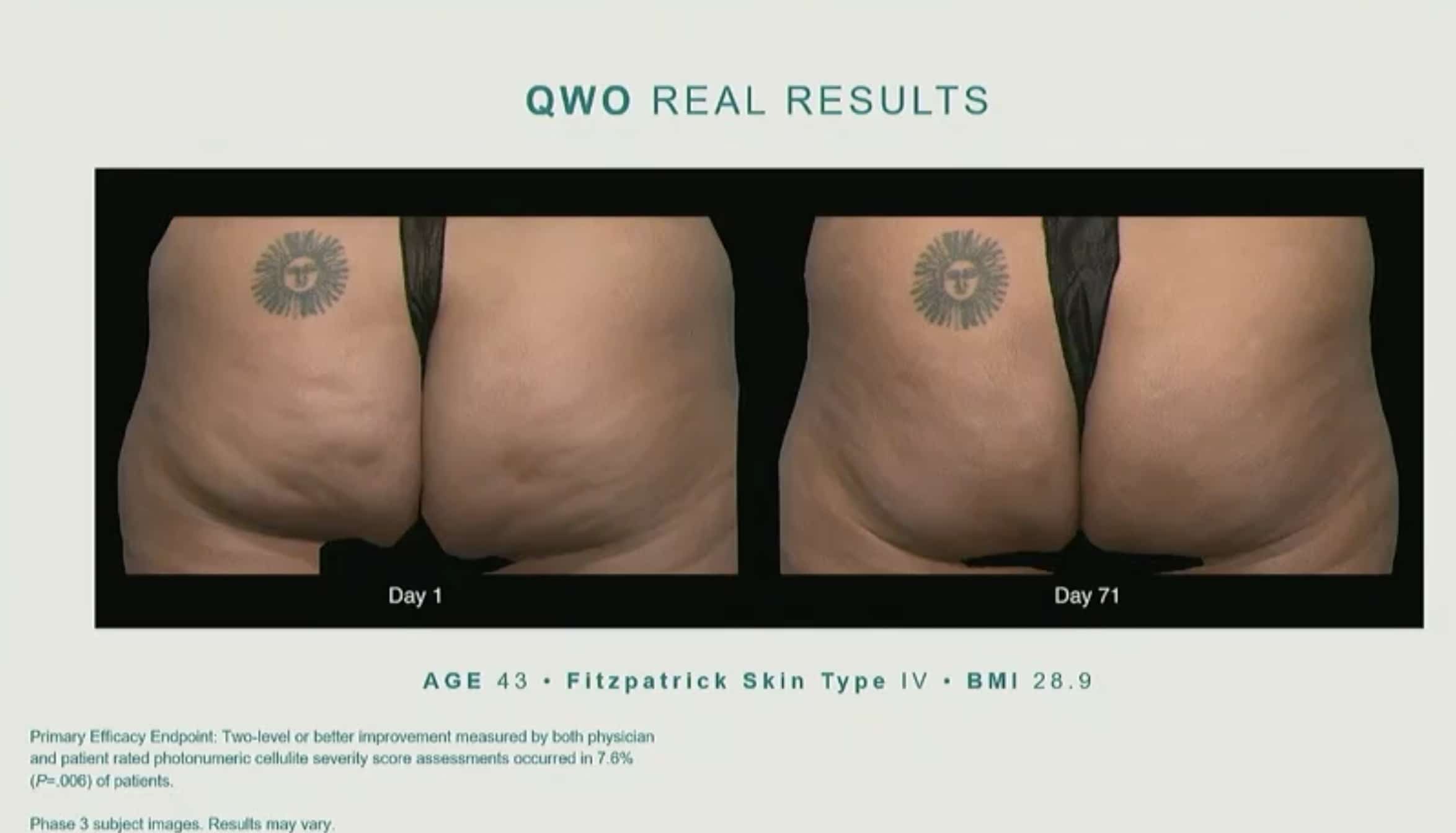 qwo cellulite before and after treatment