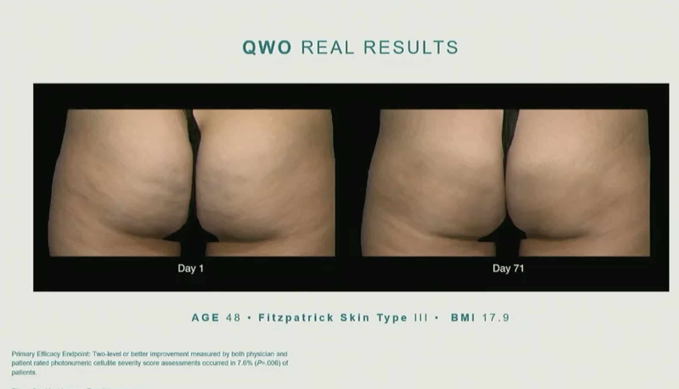 qwo real results skin type before and after