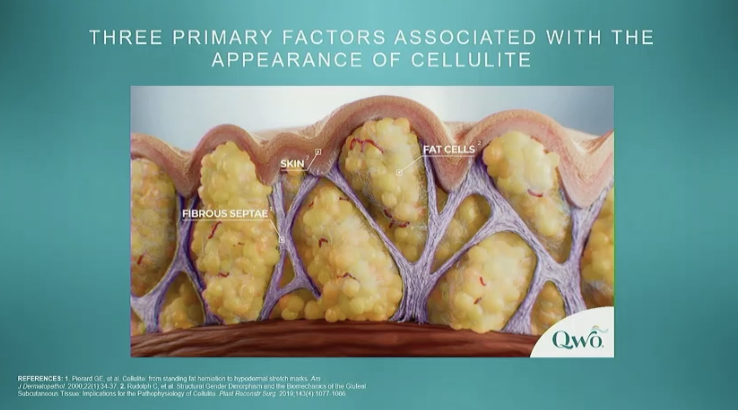three primary factors of cellulite